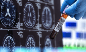 alzheimers blood test npr