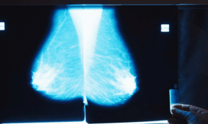 ai for breast cancer stat