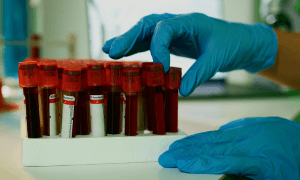 alzheimers detection medical xpress