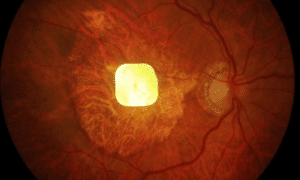 prosthetic eye science alert